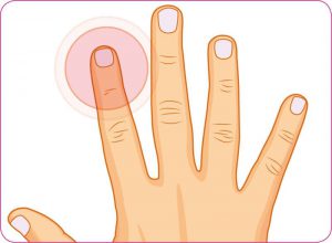 Finger nagelbettentzündung wildes fleisch Nagelbettentzündung: Symptome